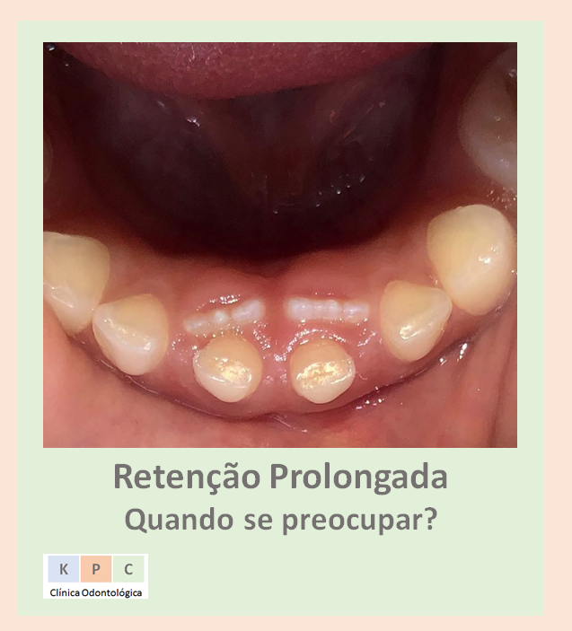 Retenção Prolongada