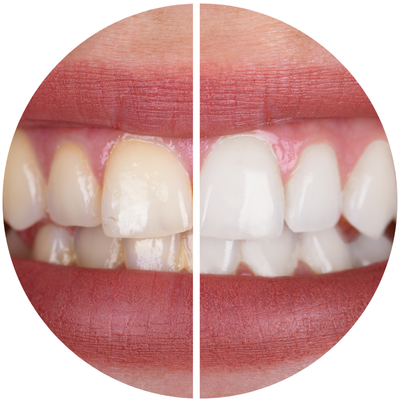 Clareamento dental - Dra. Karina Caciano